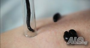 Лечение с медицински пиявици