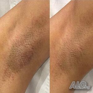 Лазерна епилация на ЦЯЛО ТЯЛО 180е+БОНУС 🌸 Почистване на лице с 💎 Диамантено Дермабразио