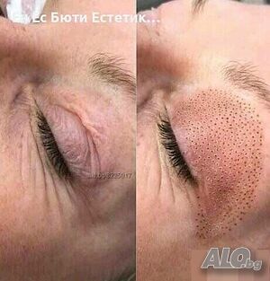 Неоперативна Блефаропластика Плазмо лифтинг